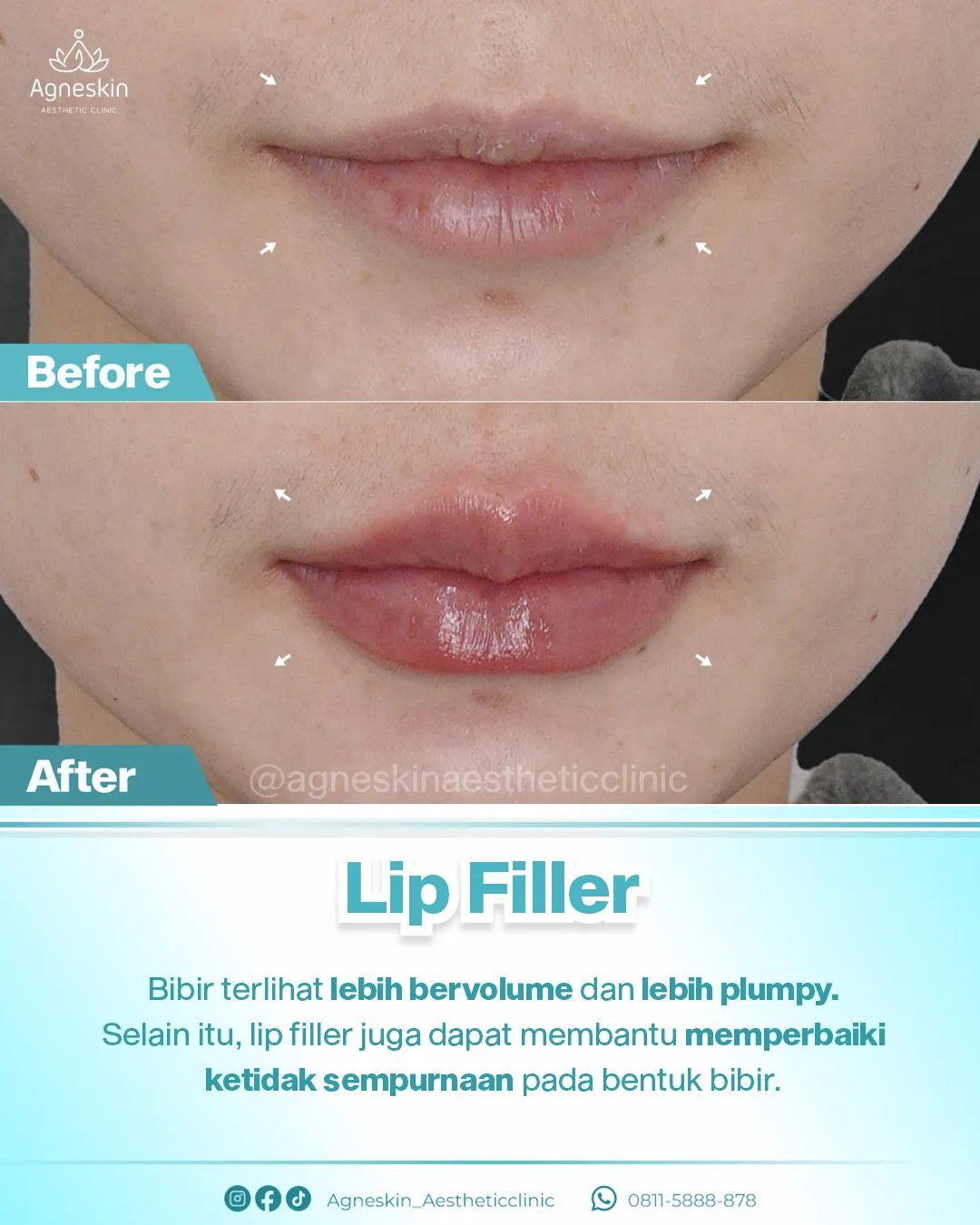 Before After Lip Filler